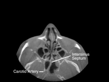Fig. 16.3, Axial CT image demonstrating the sphenoid intersinus septum curving toward the right carotid canal.