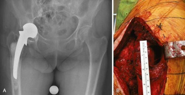 Fig. 19.2, The previous hip exposure used at the time of hemiarthroplasty (A) for hip fracture was a direct lateral abductor splitting approach. At revision (B), the anterior 60% of the hip abductor musculature was absent with failure of the previous repair and the “bald eagle” sign of a bare trochanter, along with a large anterior defect of abductors and hip capsule.