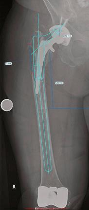 Fig. 19.5, Digital templating for a revision femoral component. The radiograph must be a long film to include the femur and must be of sufficient length for revision femoral component templating so the component, as well as the acetabular component, can be revised. A ball marker of known dimension (2.54 cm) or the known femoral head diameter allows for size calibration.