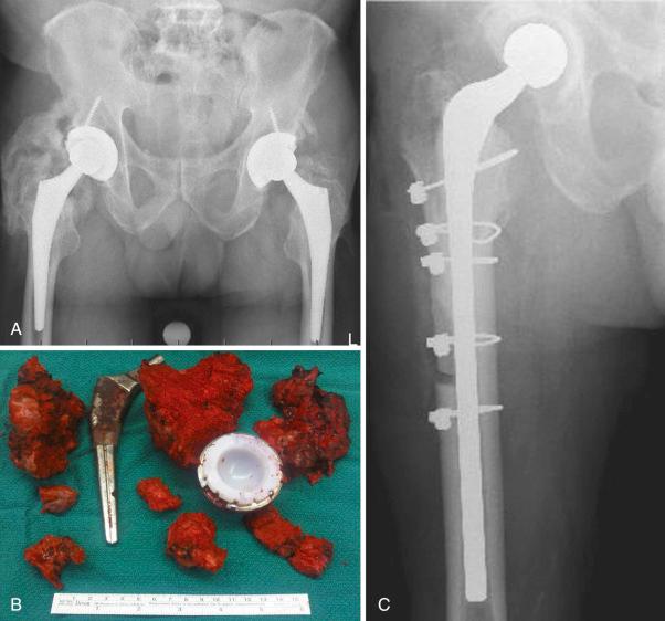 Fig. 19.6, (A) Preoperative x-ray showing severe heterotopic ossification (HO) of the right hip. This patient has an infected total hip arthroplasty with a draining sinus. (B) Removal of the extensive HO, exposure of the hip, and removal of the cementless femoral component were facilitated by an extended trochanteric osteotomy. (C) Postoperative x-ray after revision to a prosthesis of antibiotic-loaded cement (Prostalac, DePuy, Warsaw, IN). Indomethacin was used postoperatively for HO prophylaxis for 6 weeks.