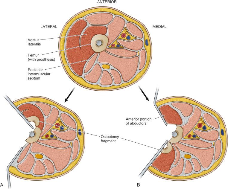 Fig. 19.7, Cross-section of the proximal femur below the level of the greater trochanter demonstrating anatomic differences between the extended trochanteric osteotomy performed via a posterolateral approach versus a modified direct lateral approach. (A) When performed through a posterolateral approach, the vastus lateralis is elevated off the posterior intermuscular septum and is retracted anteriorly. The posterior limb of the osteotomy is created first, and after the remaining anterior and distal cuts are completed, the osteotomy fragment is hinged anteriorly. Most of the vastus muscle substance remains attached to the cortical fragment and helps preserve its vascularity. (B) When performed through a direct lateral approach, the vastus lateralis is divided in midsubstance. The anterior portion of the vastus is retracted anteriorly in continuity with the anterior third of the abductors. The anterior limb of the osteotomy is created first, and after the remaining posterior and distal cuts are completed, the osteotomy fragment is hinged posteriorly. The posterior portion of the vastus muscle substance remains attached to the cortical fragment, which helps preserve its vascularity.