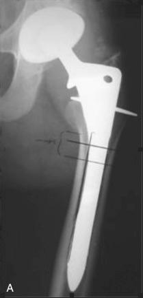 Fig. 19.8, (A) Removal of a cementless cobalt chrome cylindrical fully porous-coated stem requires preoperative planning and templating. The stem is cut below the metaphyseal flare of the implant with a metal cutting bur (diamond wheel disk or bur). (B) Femoral implant after removal. (C) The proximal metaphyseal portion is removed with Gigli saw assistance (multiple Gigli saws are necessary because they overheat and break during the procedure). Cylindrical hollow trephines are then used to trephine over the retained distal cylindrical portion of the stem. Several trephines of the same diameter are recommended because the trephine frequently cracks at the head because of fatigue and heat damage during trephining.