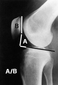 Fig. 107.12, The Blackburne-Peel method of measuring patellar height.