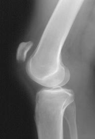 Fig. 107.13, A lateral radiograph of a patellar tendon rupture.