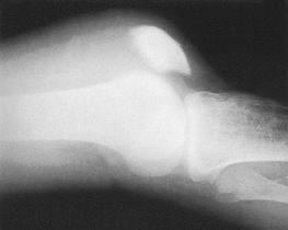 Fig. 107.14, A lateral radiograph of a quadriceps tendon rupture.