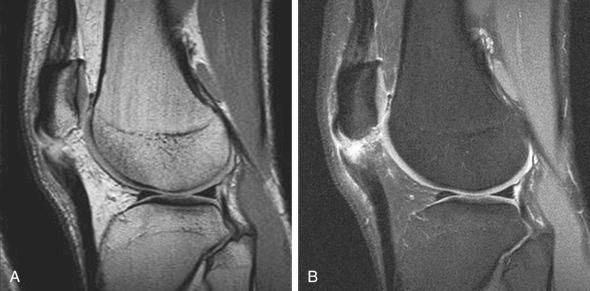 Fig. 107.15, (A and B) Magnetic resonance images of patellar tendon disruption.