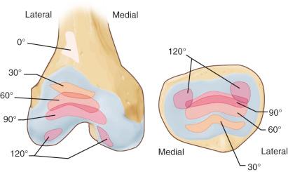 Fig. 107.4, Patellar contact areas according to degrees of knee flexion.