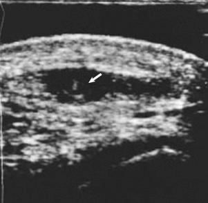 Fig. 107.8, Ultrasound of a knee and patellar tendon.