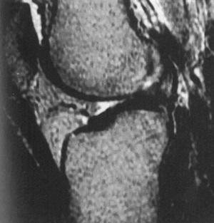 Fig. 107.9, A magnetic resonance image of the knee showing thickening of the patellar tendon.