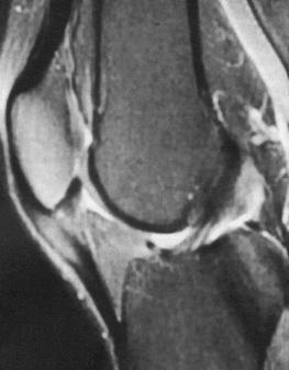 Fig. 107.10, A magnetic resonance image of the knee showing high signal intensity within the tendon.