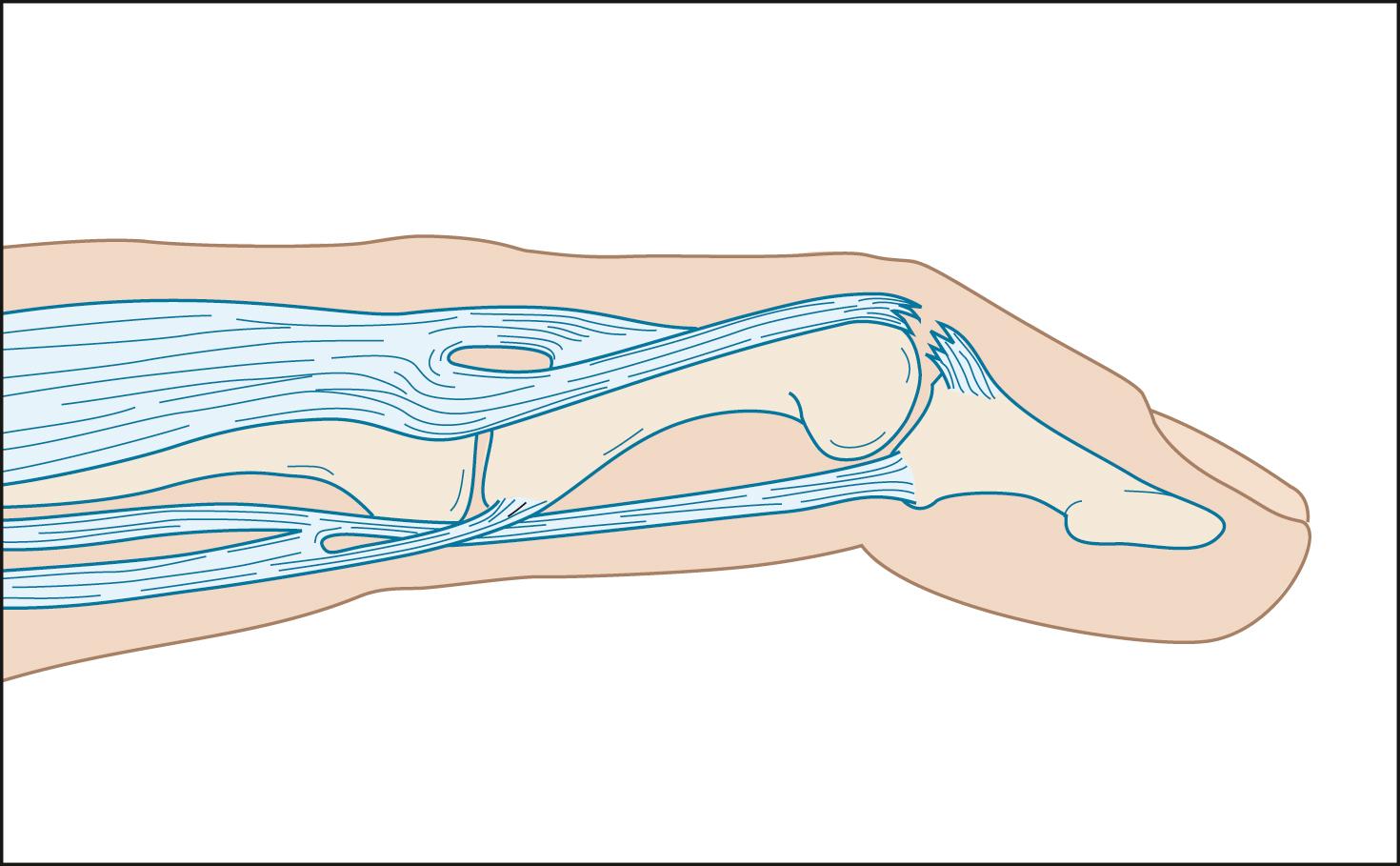 Fig. 106.1, Injured distal interphalangeal joint in slight flexion.