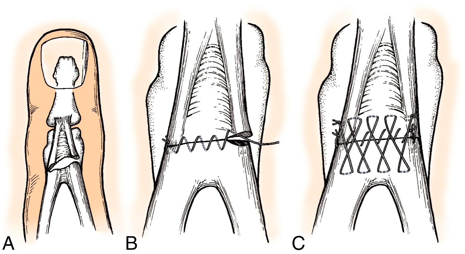 Fig. 5.11, Relatively thin extensor tendon just proximal to DIP joint can be repaired with this technique. A, Sharp laceration in zone 2 of the extensor tendon. B and C, Laceration repaired with a running suture (B) and oversewn with a Silfverskiöld cross-stitch (C) .