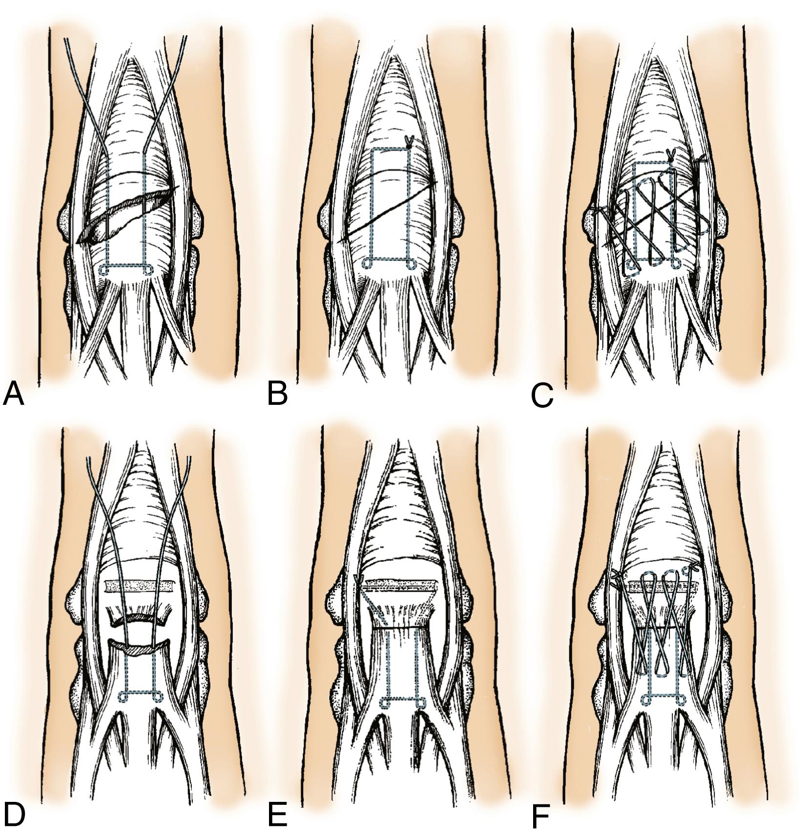 Fig. 5.12, Doyle’s preferred technique for repair of zone 3 lacerations. A to C, Central slip laceration with sufficient tendon to repair with core suture and oversew with Silfverskiöld epitendinous stitch. D to F, Core stitch can be passed through trough in the base of the middle phalanx when the tendon laceration is distal, leaving a small stump of central slip.