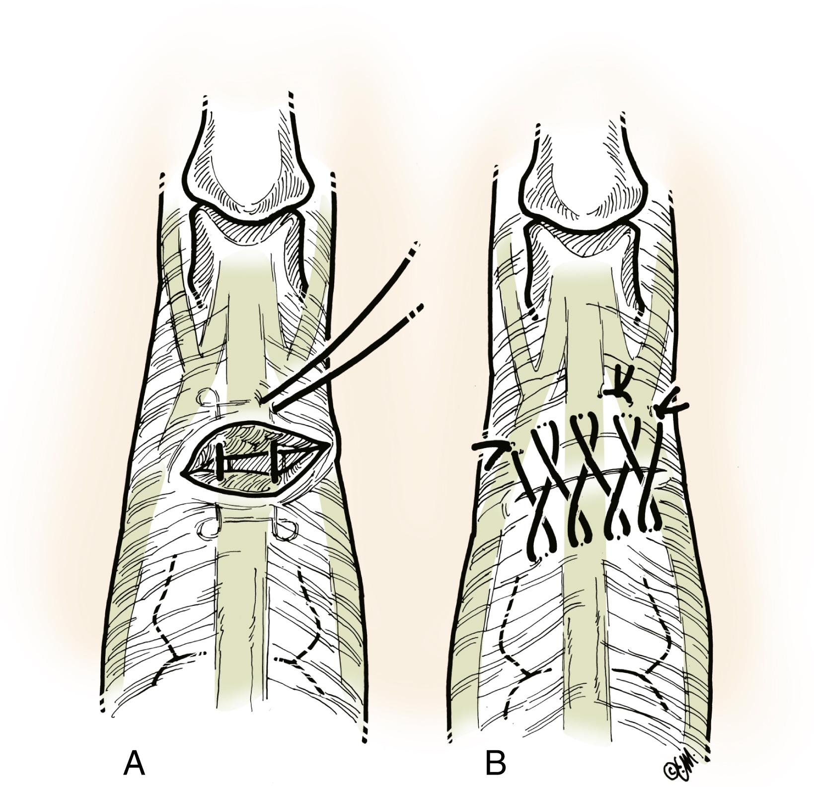 Fig. 5.13, The author’s recommended technique for suture of zone 4 extensor tendon injuries. A, Modified Kessler suture is centered over the laceration and tied with suitable tension to avoid gapping or undue shortening of the tendon. The distance between longitudinal components of the suture is adjusted to avoid side-to-side “bunching” or shortening. Alternatively, two modified Kessler core sutures may be placed to avoid bunching of the repair. The relative increased thickness of lateral bands is used for placement of the longitudinal portions of the suture to obtain maximal holding power. B, The suture is “finished” with a cross-stitch to augment the repair further. This repair is well suited to the curvature of the extensor tendon over the proximal phalanx and the relative thinness of the tendon.