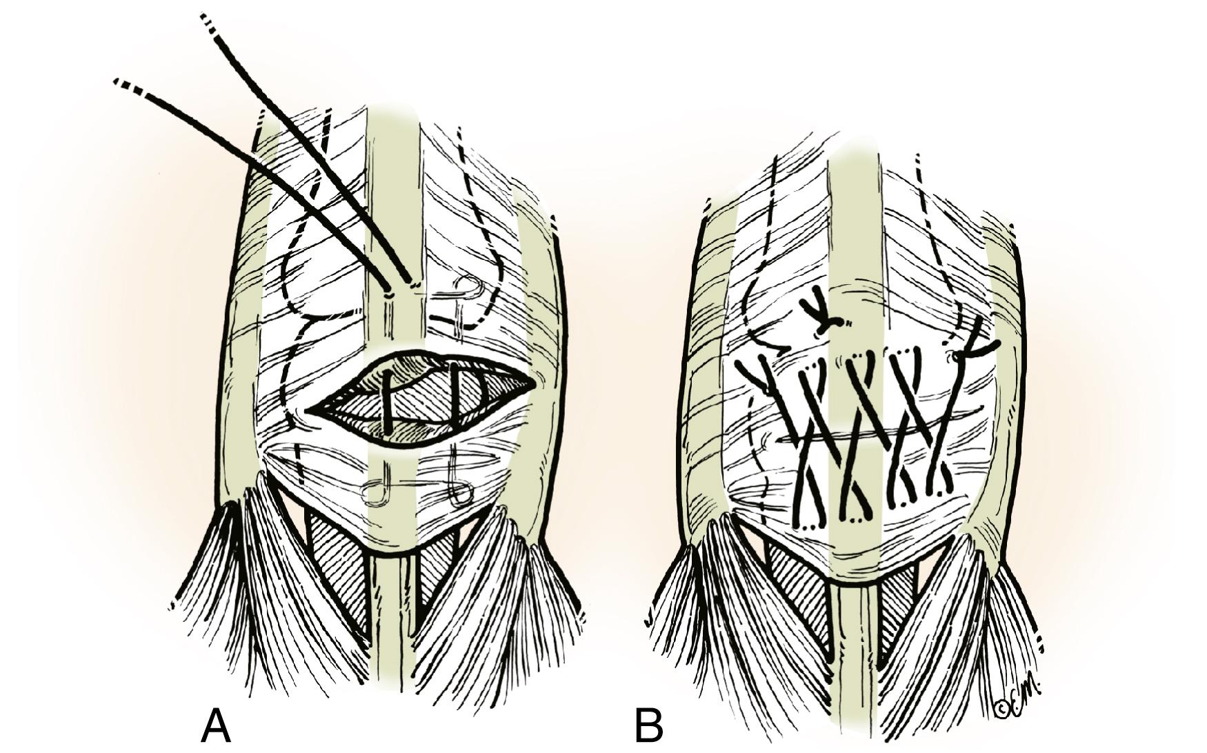 Fig. 5.14, Lacerations over MP joint (zone 5) are in a region of increased thickness and substance compared with the extensor tendon mechanism distally. A and B, The author’s preferred technique for repair of lacerations in this zone includes the modified Kessler (A) , followed by the cross-stitch (B) .