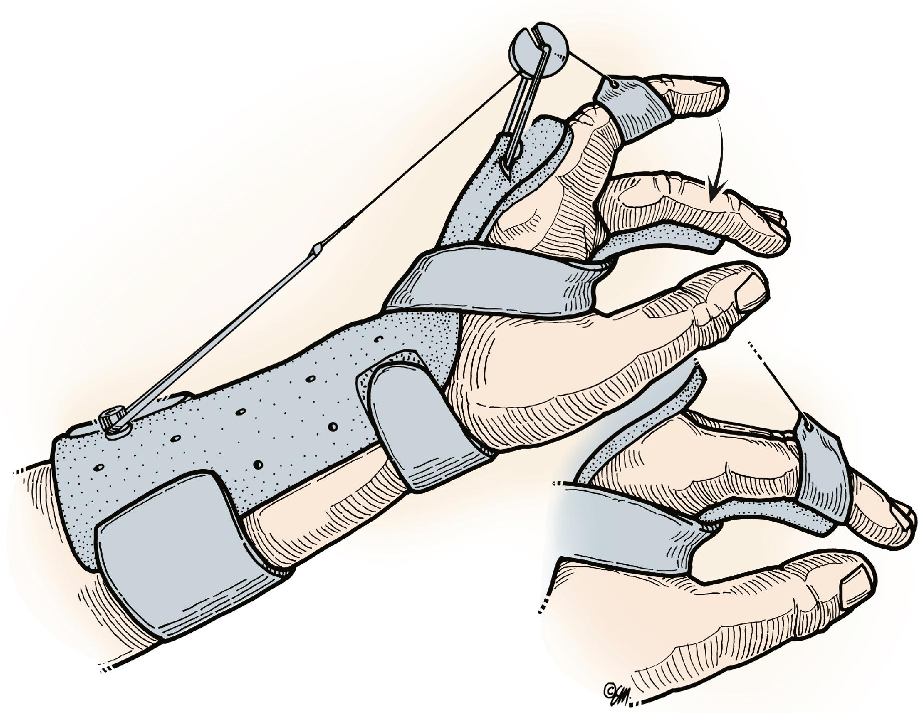 Fig. 5.15, Dynamic splint for early motion of extensor tendon injuries. Elastic traction maintains fingers in extension. Excursion of the repaired extensor tendon is achieved by active flexion. Splinting is started 3 to 5 days after surgery and is maintained for 5 weeks. Active flexion is performed 10 times an hour. See text for details.