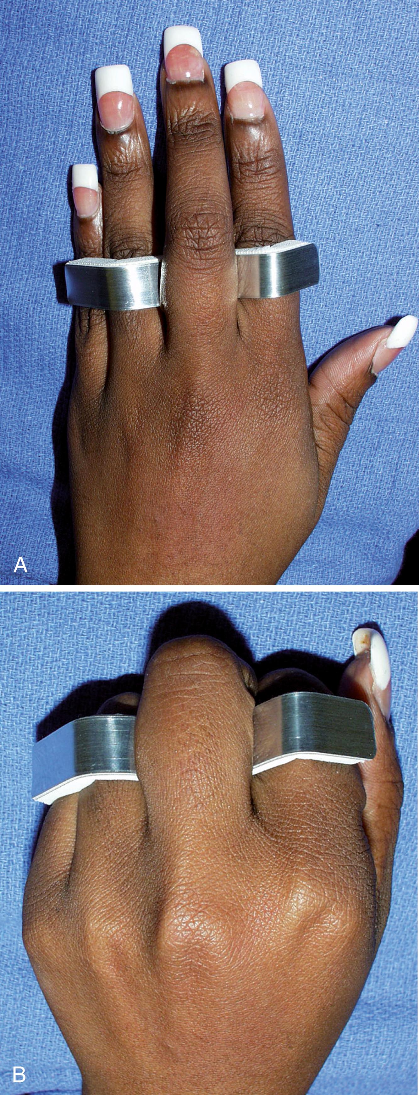 Fig. 5.16, Relative motion splint. A, Aluminum foam finger splint or splint custom made by a hand therapist is used to offload extensor mechanism. This splint is also used for sagittal band injury treatment. Splint should hold injured MP joint in about 25 degrees of extension relative to adjacent digits. B, Full active motion of MP and IP joints is allowed with splint in place.