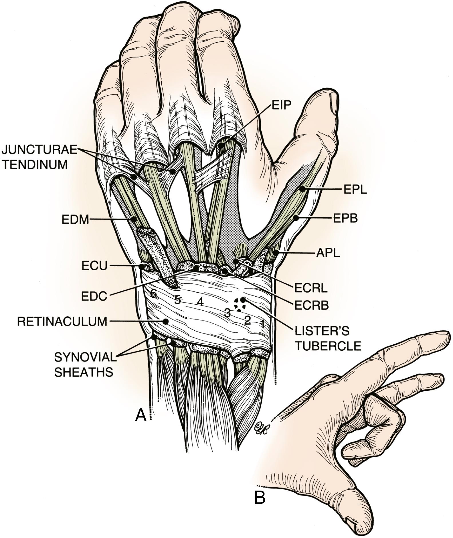 Fig. 5.2, A, Extensor tendons gain entrance into the hand from the forearm through a series of six canals, five fibroosseous canals, and one fibrous canal (the fifth dorsal compartment, which contains the EDM). The first compartment contains the APL and EPB; the second, radial wrist extensors; the third, the EPL, which angles around the Lister tubercle; the fourth, the EDC to the fingers and EIP; the fifth, the EDM; and the sixth, the ECU. The communis tendons are joined distally near the MP joints by fibrous interconnections called juncturae tendinum. These juncturae are found only between the communis tendons and may aid in surgical recognition of the proprius tendon of the index finger. The proprius tendons are usually positioned to the ulnar side of the adjacent communis tendons, but variations may be present that alter this arrangement (see text discussion). Beneath the retinaculum, the extensor tendons are covered with a synovial sheath. B, Proprius tendons to the index and little fingers are capable of independent extension, and their function may be evaluated as depicted. With the middle and ring fingers flexed into the palm, the proprius tendons can extend the ring and little fingers. Independent extension of the index finger is not always lost after transfer of the indicis proprius, however, and is less likely to be lost if the extensor hood is not injured and is probably never lost if the hood is preserved and the junctura tendinum between the index and middle fingers is excised. This figure represents the usual anatomic arrangement found over the wrist and hand, but variations are common, and the reader is referred to the section on anatomic variations.