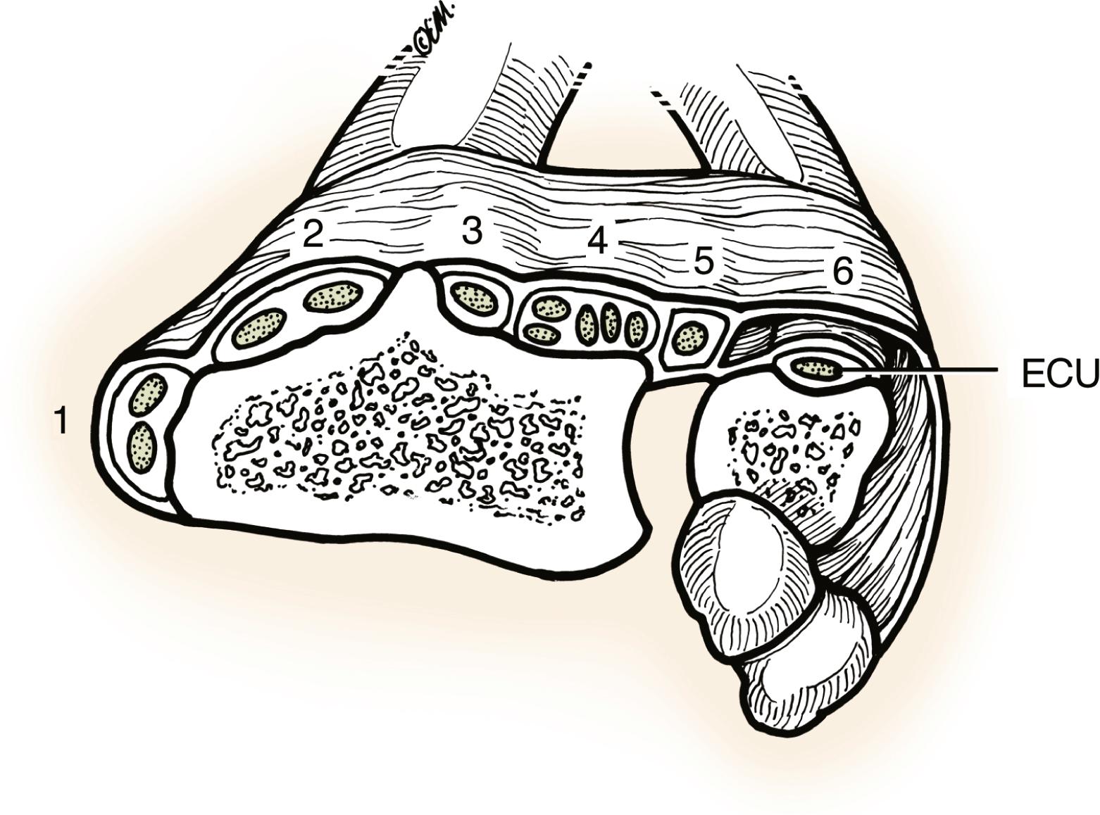 Fig. 5.3, ECU lies in a separate fibroosseous tunnel or subsheath. The extensor retinaculum lies superficial to and does not attach to the ulna but swings around and attaches to the pisiform and triquetrum.