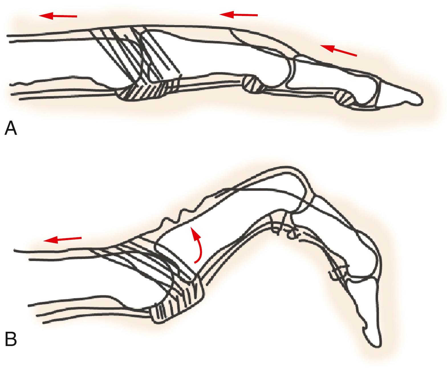 Fig. 5.4, A, EDC allows extension of MP joint via insertion onto the sagittal bands, which “lasso” around the base of the proximal phalanx. There is usually no tendinous insertion of EDC to the dorsal base of the proximal phalanx. When MP joint hyperextension is prevented, EDC is capable of extending MP, PIP, and DIP joints even in the absence of intrinsic muscle function. B, When MP joint hyperextension is allowed, as with intrinsic paralysis, “slack” develops in EDC system distal to the sagittal bands, in addition to increased tone in the flexor system, all producing a flexion posture at the PIP and DIP joints, or claw finger.