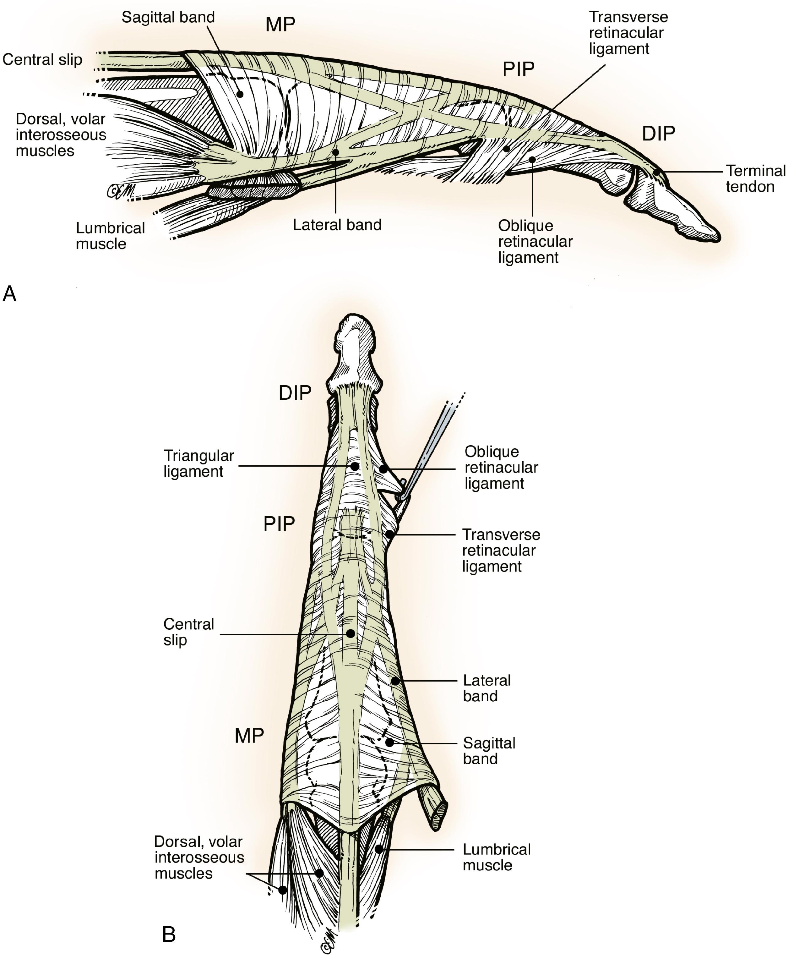 Fig. 5.5, A and B, Extensor tendon at MP joint level is held in place by the transverse lamina or sagittal band, which tethers and centers the extensor tendons over the joint. This sagittal band arises from the volar plate and the intermetacarpal ligaments at the neck of the metacarpals. Any injury to this extensor hood or expansion may result in subluxation or dislocation of the extensor tendon. Intrinsic tendons from lumbrical and interosseous muscles join the extensor mechanism at about the level of the proximal portion and midportion of the proximal phalanx and continue distally to the DIP joint of the finger. Extensor mechanism at the PIP joint is best described as a trifurcation of the extensor tendon into the central slip, which attaches to the dorsal base of the middle phalanx, and the two lateral bands. These lateral bands continue distally to insert at the dorsal base of the distal phalanx. Extensor mechanism is maintained in place over PIP joint by transverse retinacular ligaments.