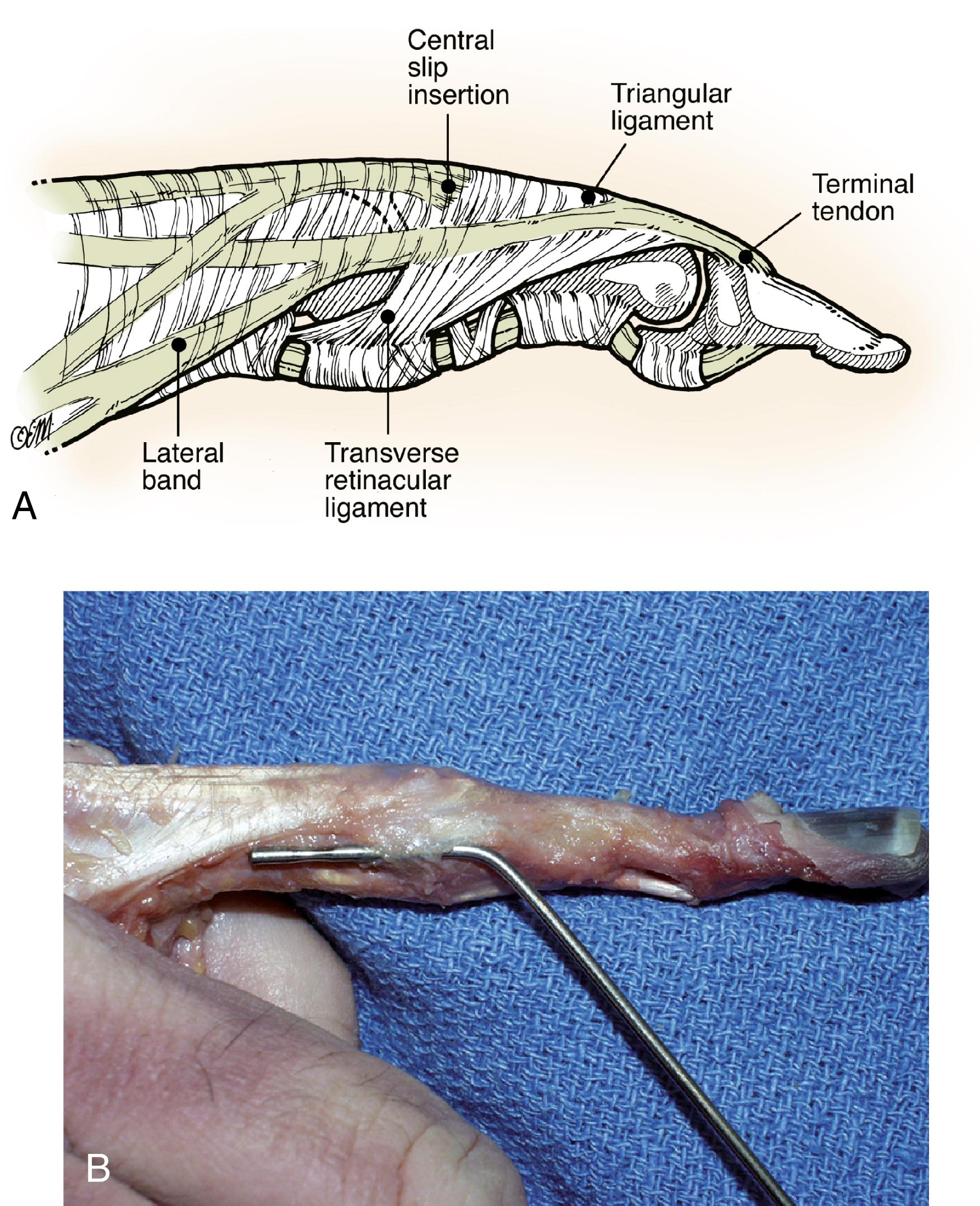 Fig. 5.6, A, Illustration of extensor mechanism at PIP joint level. B, Cadaver finger dissection showing probe beneath transverse retinacular ligament at level of PIP joint.