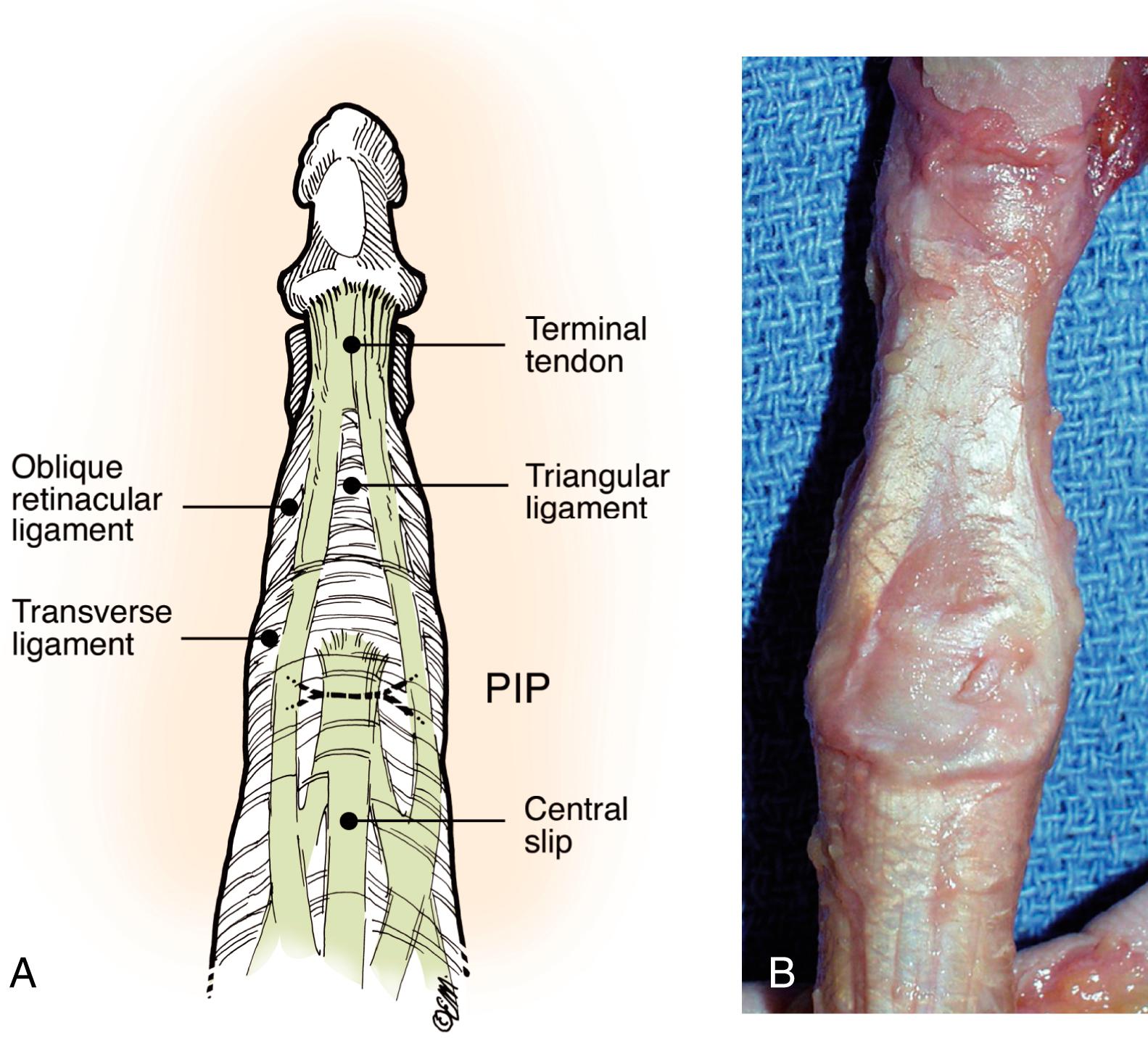 Fig. 5.7, A, Triangular ligament. B, Cadaver triangular ligament.