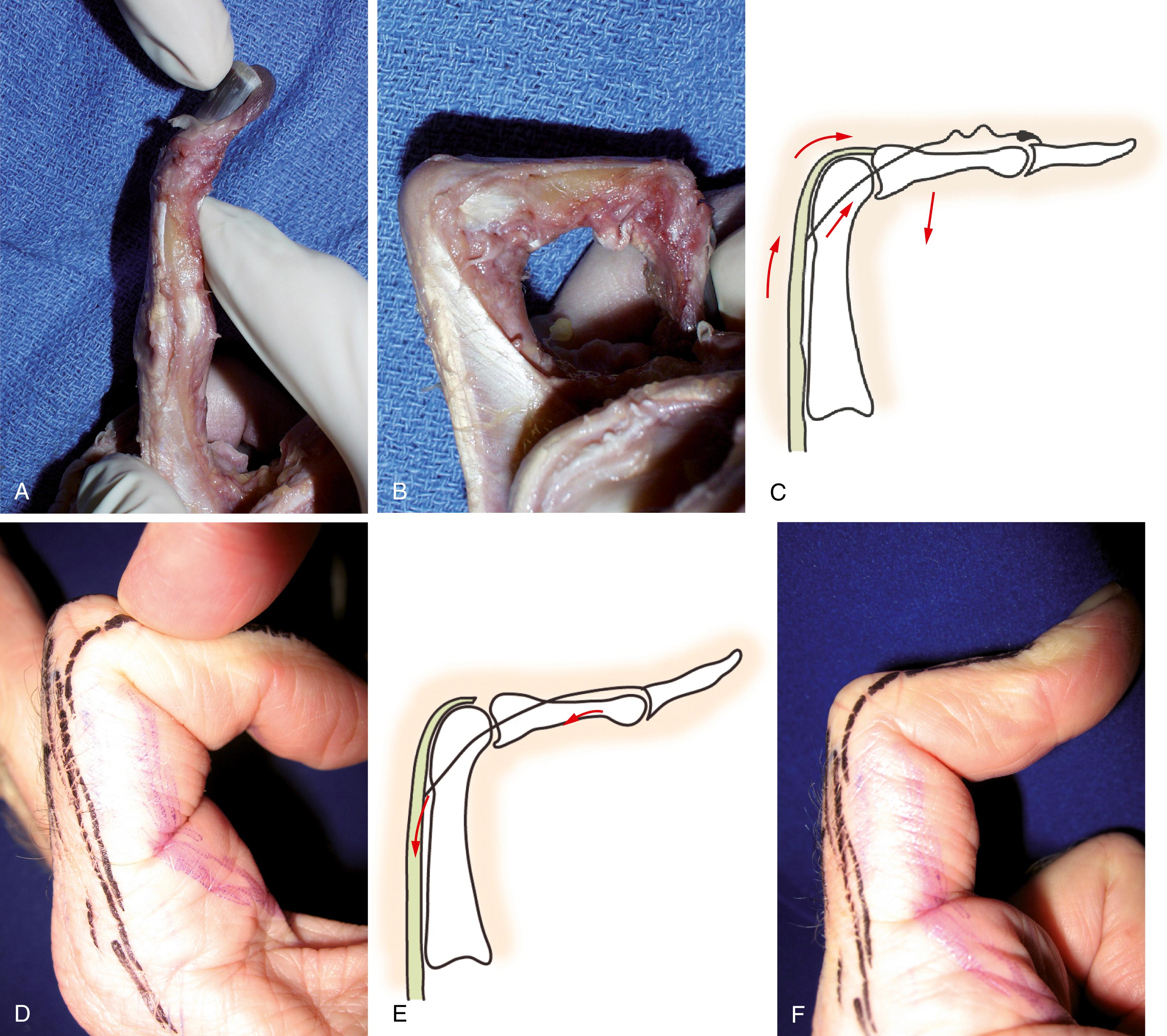 Fig. 5.8, A, Maximal passive PIP joint extension prohibits full DIP joint flexion by normal tension in lateral bands. B, Full PIP joint flexion allows slack in the lateral bands, permitting full DIP joint flexion. C, Maximal passive flexion of PIP joint induces slack in the lateral bands via proximal interconnections, resulting in loss of power of active DIP joint extension and increased DIP joint flexion. D, Finger maximally flexed prohibits any ability to extend DIP joint actively. E, Injury to central slip eliminates the slack in the lateral bands produced by passive PIP joint flexion and allows extensor tension to be generated at DIP joint. This is the basis for the Elson test. F, With central slip injury, DIP joint can be actively extended with maximum PIP joint flexion.