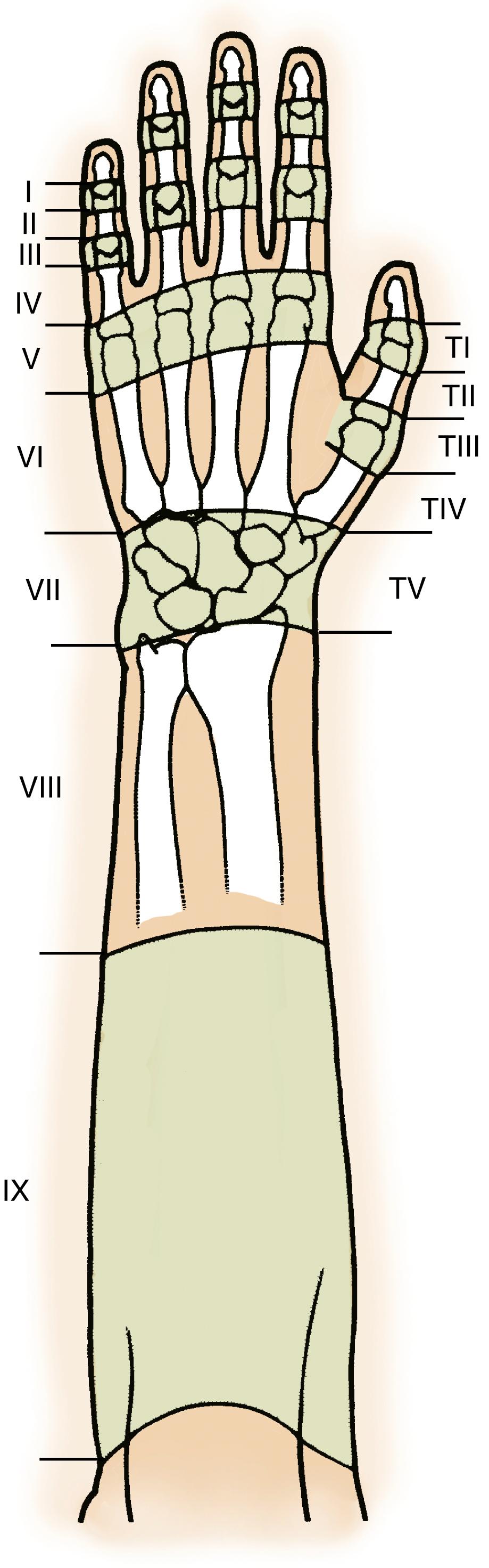 Fig. 5.9, Zones of extensor tendon injury.