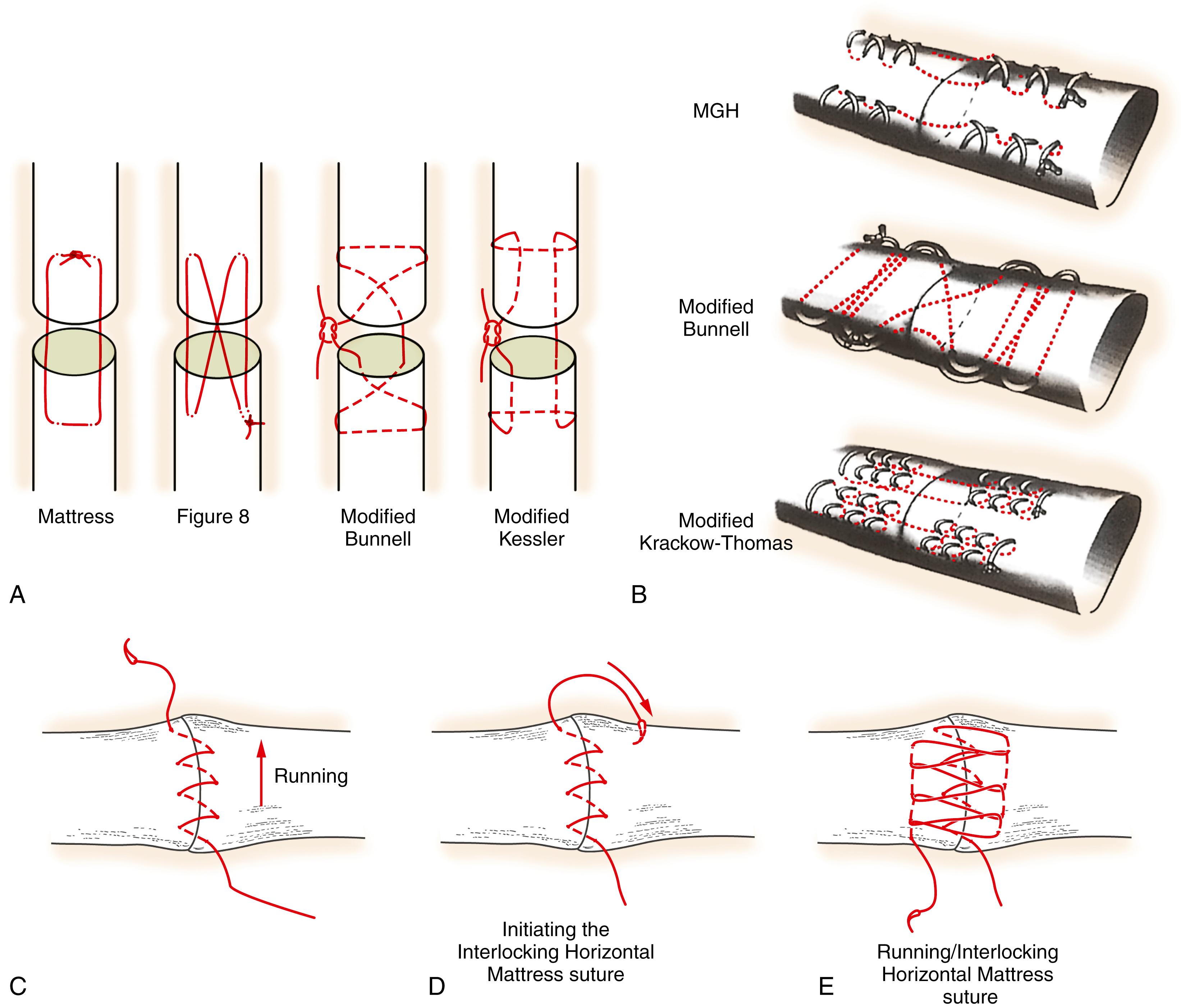 Fig. 5.10, A, Modified Bunnell suture was the strongest suture with the least loss of MP or PIP joint motion. B, Schematic representation of four-strand MGH, modified Bunnell, and modified Krackow-Thomas repairs. C, Starting running suture of corset suture. This suture configuration was evaluated in zone 6 but may be used in any zone. It does not employ any core sutures. D, Initiating the interlocking horizontal mattress suture. E, Completed running interlocking horizontal mattress suture.