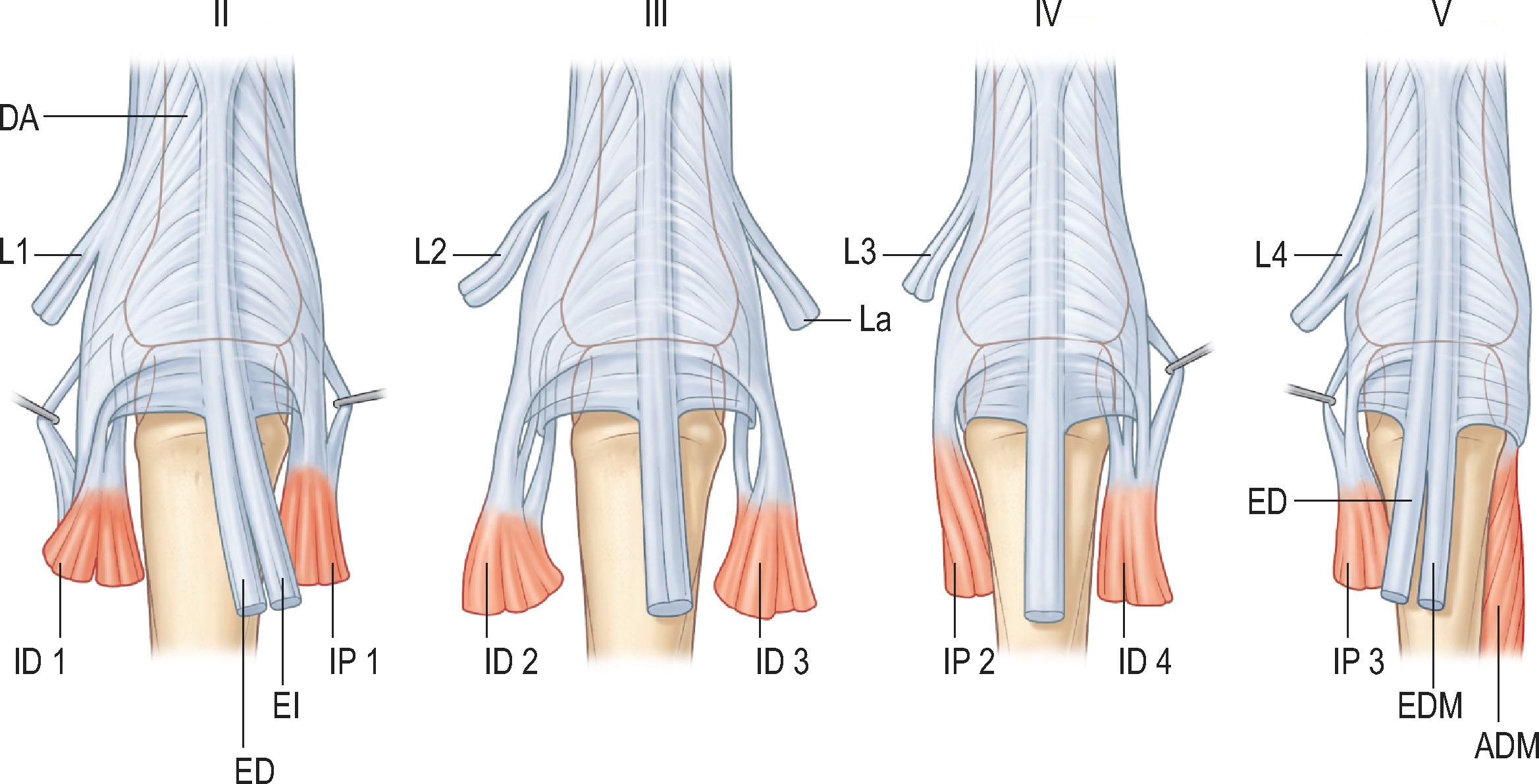 Figure 10.3, The distribution of intrinsic muscles in the fingers. Roman numbers indicate finger numbers. ADM, Abductor digiti minimi; DA, dorsal aponeurosis; ED, extensor digitorum; EDM, extensor digiti minimi; EI, extensor indicis; ID, dorsal interosseous muscles; IP, palmar interosseous muscles, numbered from radial to ulnar; L, lumbrical muscles, numbered from radial to ulnar; La, accessory lumbrical muscle (variation).