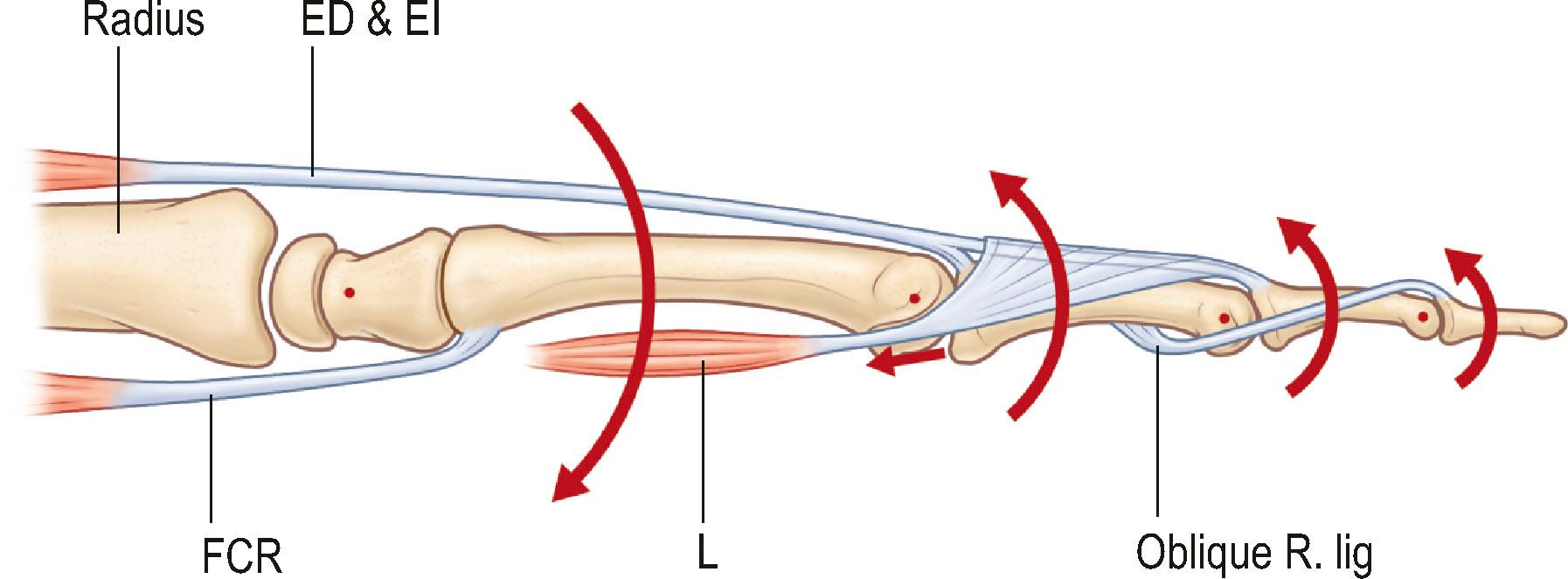 Figure 10.4, Linked chains. ED & EI, Extensor digitorum and extensor indicis; FCR, flexor carpi radialis; L, lumbrical muscle; Oblique R. lig, oblique retinacular ligament (Landsmeer's ligament).