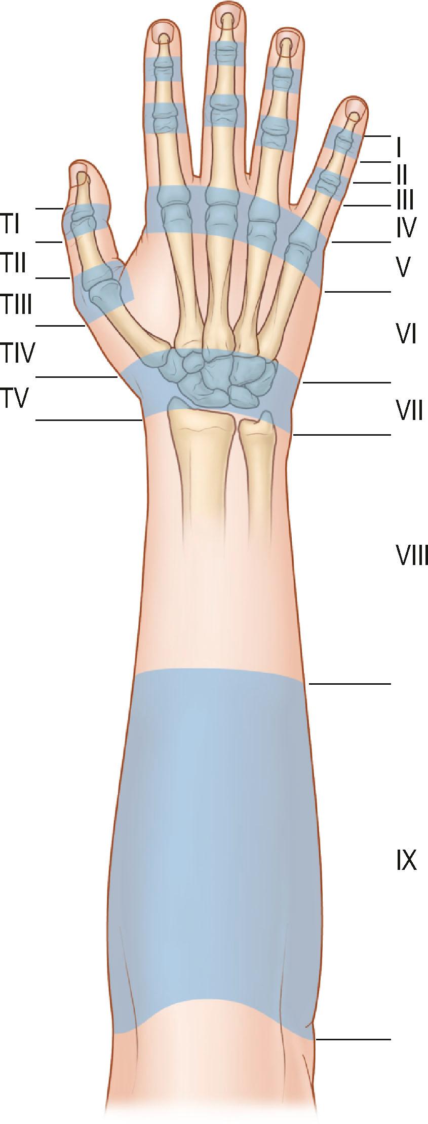 Figure 10.6, The zones of extensor tendon injuries.