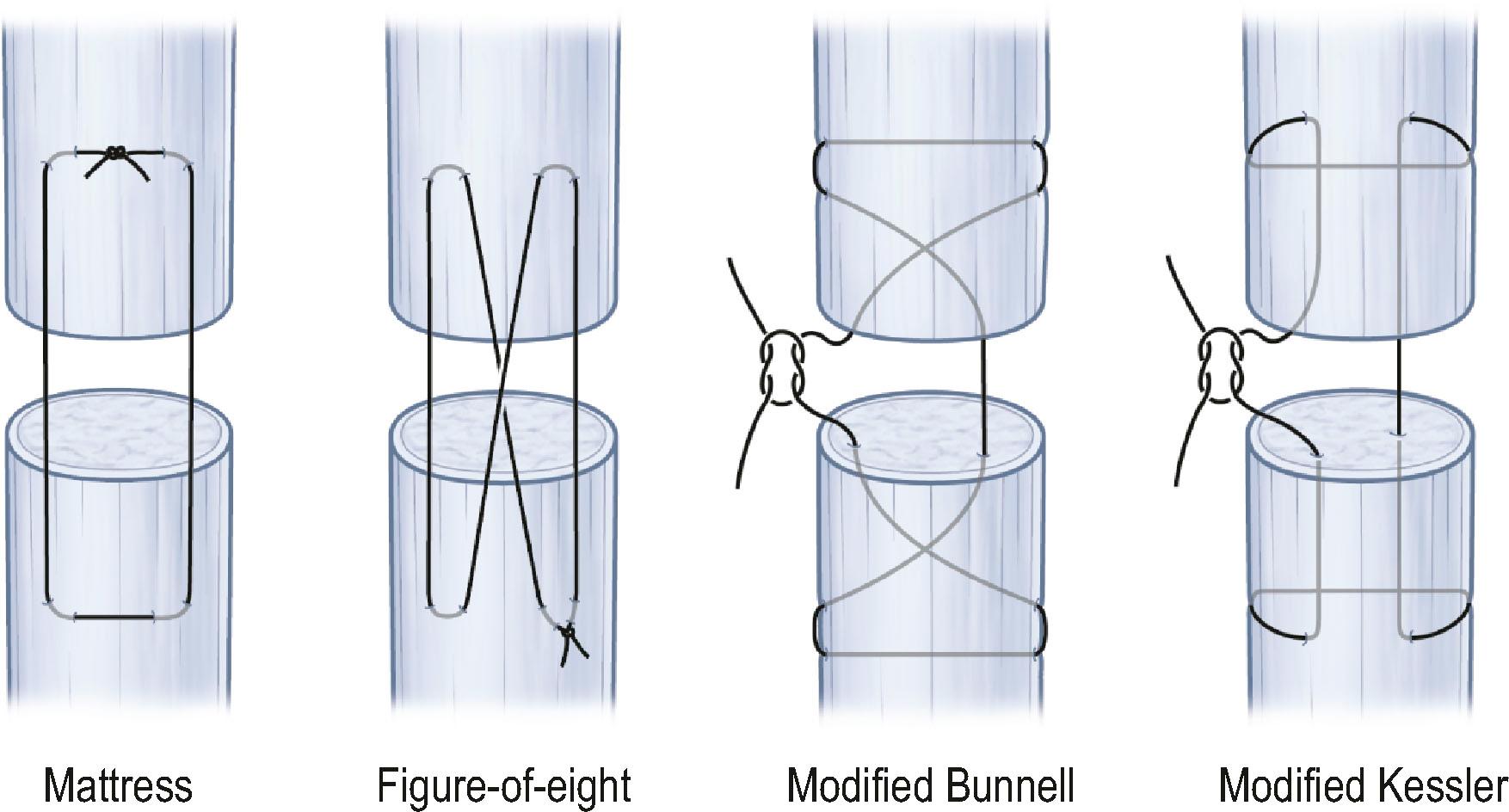 Figure 10.7, Different types of core sutures.