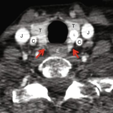 Fig. 49.2, Arrows demarcate location of right and left tracheoesophageal grooves. C, common carotid artery, E, esophagus, J, internal jugular vein, T, thyroid gland.