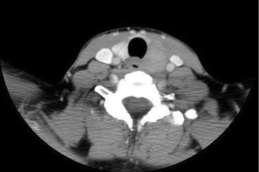 Fig. 49.3, A 67-year-old man presents with hoarseness for 2 months. On examination he has a 3-cm left thyroid mass, no palpable lymphadenopathy but left recurrent laryngeal palsy. Image shows a CT scan with contrast. He undergoes a thyroidectomy and central node dissection. He has extensive extrathyroid extension, tumor is dissected of left RLN and trachea, and microscopic residual disease left behind. Pathology reveals a 3.5-cm papillary thyroid cancer with 30% tall cell changes and extrathyroid extension. All identified nodes are negative. He has 150 mCi RAI, with uptake in central neck, his stimulated TSH is 67, and thyroglobulin is 11.2 with negative antibodies. RAI is followed by external beam radiotherapy 60 Gy in 30 fractions, to thyroid bed and 54 Gy to low-risk nodal volume.