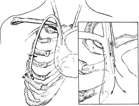 FIGURE 2, Diagram shows tunneled catheter exit site on the anterior chest wall. Rib numbers are indicated.