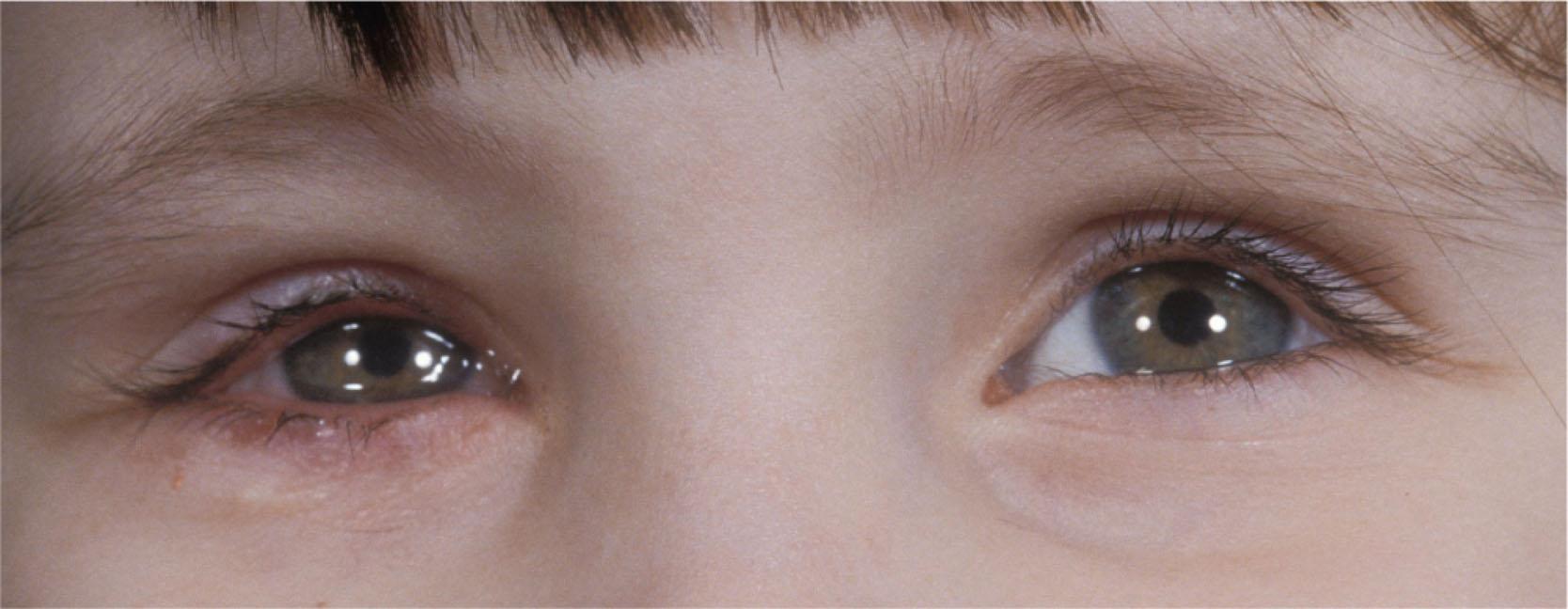 Fig. 15.2, Red and watery right eye of child with blepharokeratoconjunctivitis. There is anterior blepharitis and a reactive ptosis.