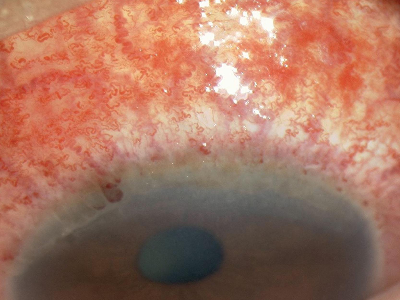 Fig. 15.12, Neisseria gonorrhoeae conjunctivitis. There is intense congestion of the vessels with petechial hemorrhages. There may be a hyperpurulent discharge and a tendency for corneal thinning at the superior limbus.