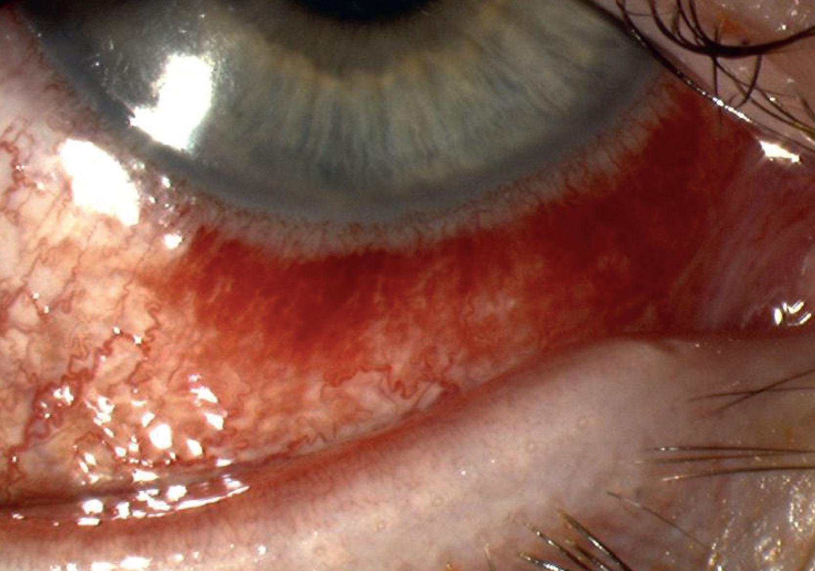 Fig. 15.13, Primary Neisseria meningitidis conjunctivitis in a child age 16 years. Subconjunctival hemorrhages and epithelial defects are a common feature.