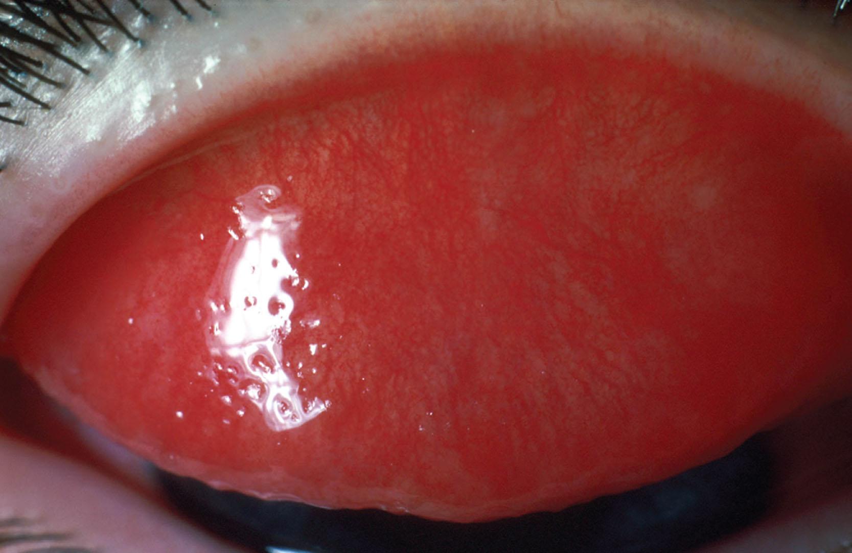 Fig. 15.14, Intense papillary conjunctival response over the upper tarsal plate in acute adenovirus infection. A follicular change may predominate over the lower tarsal conjunctiva.