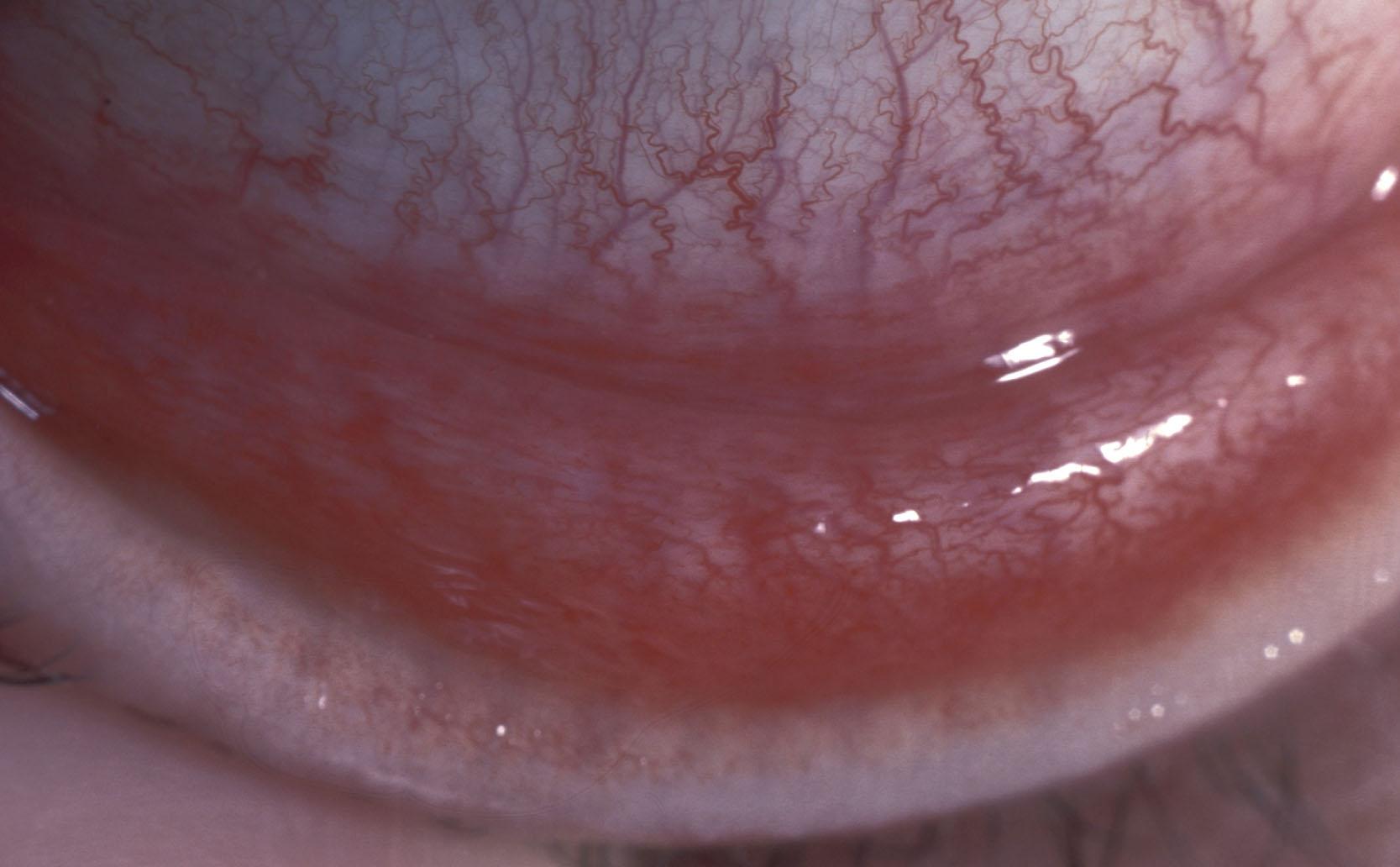 Fig. 15.16, A mild follicular conjunctivitis associated with herpes simplex infection. Confirmed by polymerase chain reaction.