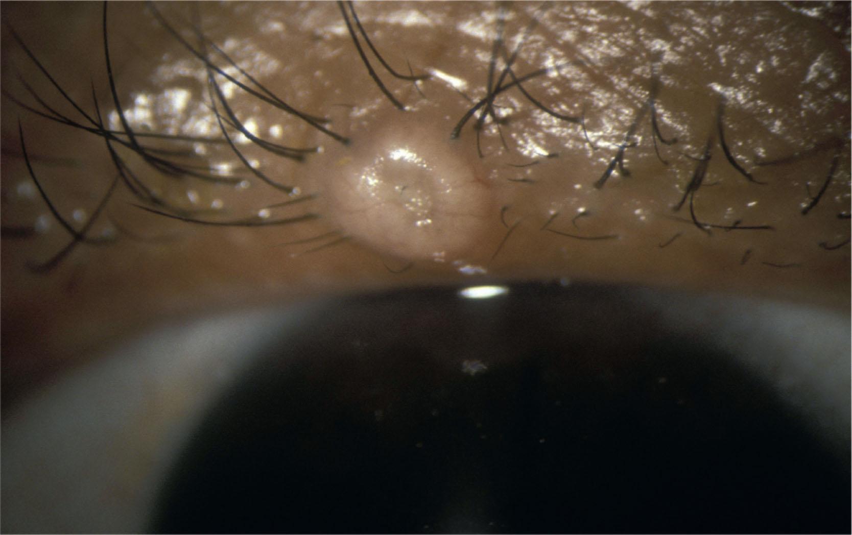 Fig. 15.17, An umbilicated lesion of molluscum contagiosum on the lid margin. There may be an associated follicular conjunctivitis and corneal vascularization in neglected cases.