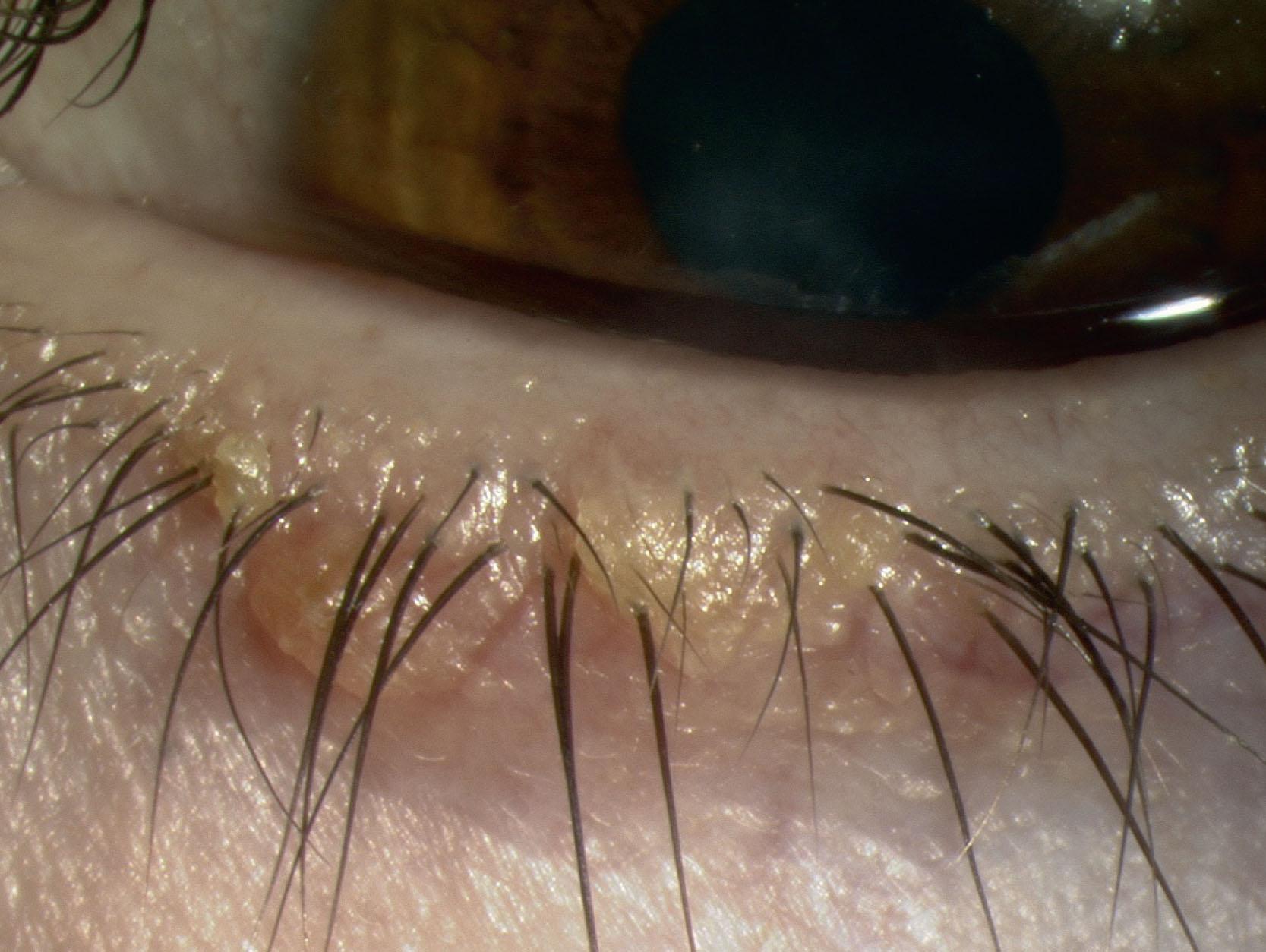Fig. 15.3, Crusting at the base of the lashes in anterior blepharitis.