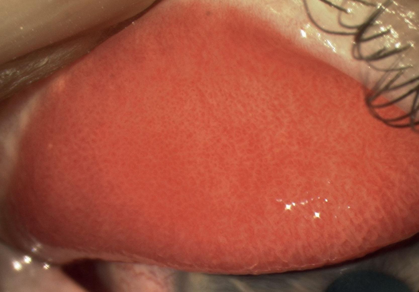 Fig. 15.4, A predominantly papillary response in a patient with very active blepharokeratoconjunctivitis.