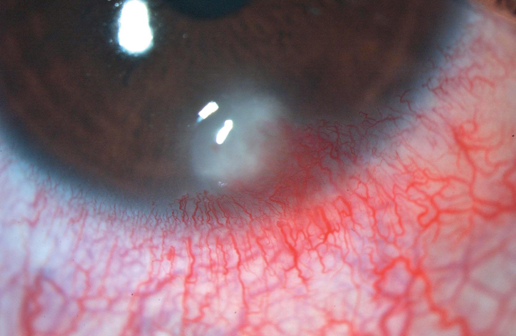 Fig. 15.5, Acute phlyctenule at the limbus. The lesion is raised with an epithelial defect. There is early corneal vascularization.