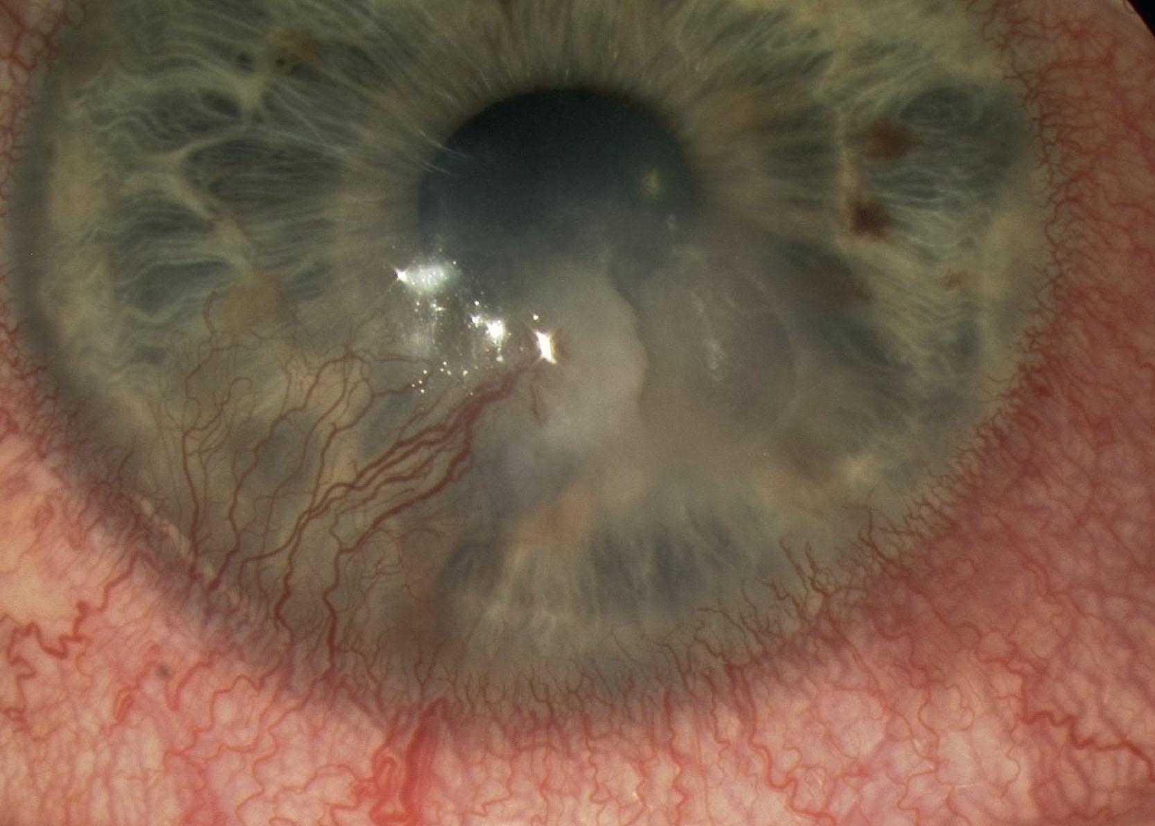 Fig. 15.6, A recurrent corneal phlyctenule. There is scar, thinning, and vascularization of the cornea that reduce vision.