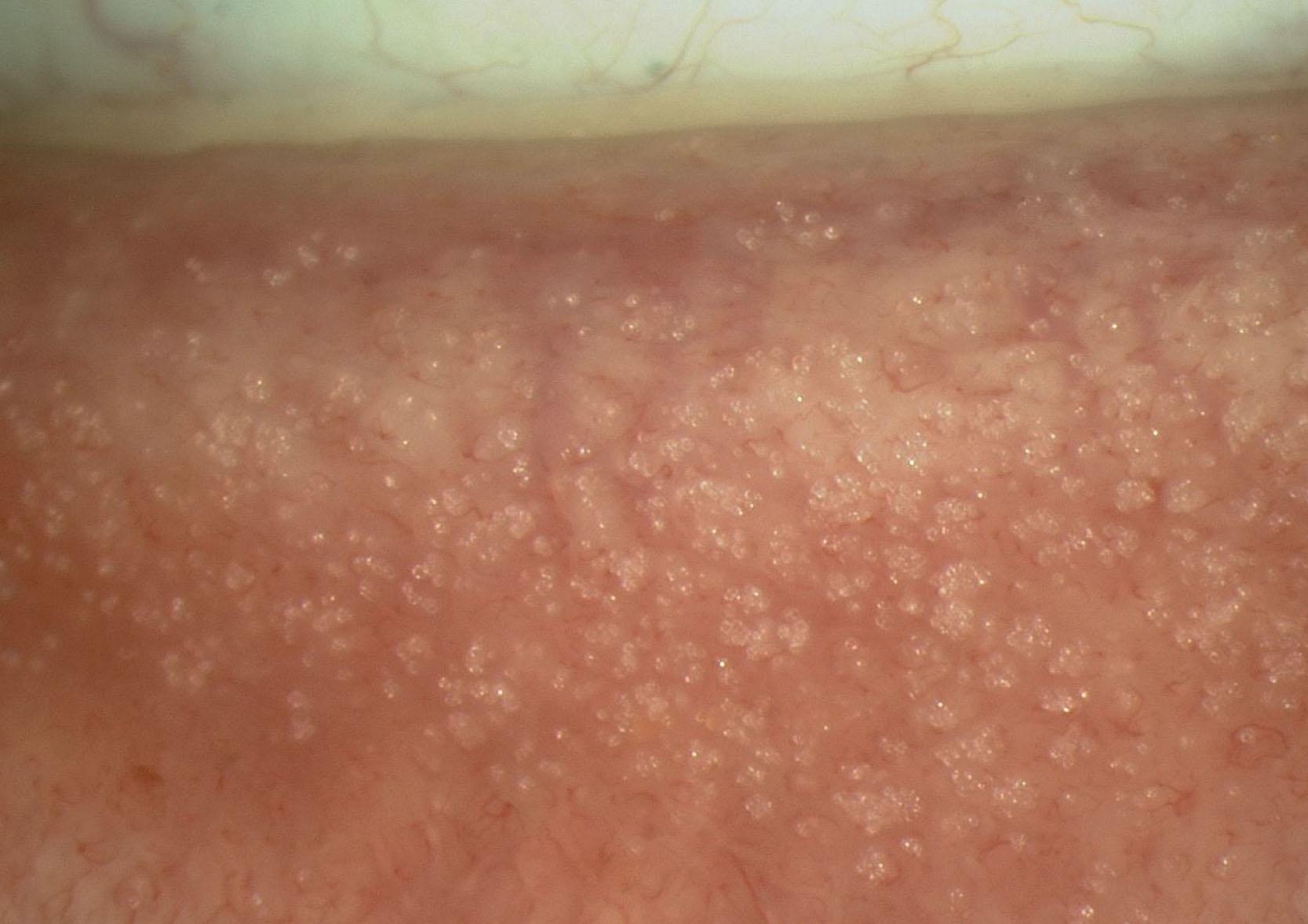 Fig. 15.7, Numerous subconjunctival crystalline deposits in blepharokeratoconjunctivitis shown in the tarsal conjunctiva of the everted lower lid.