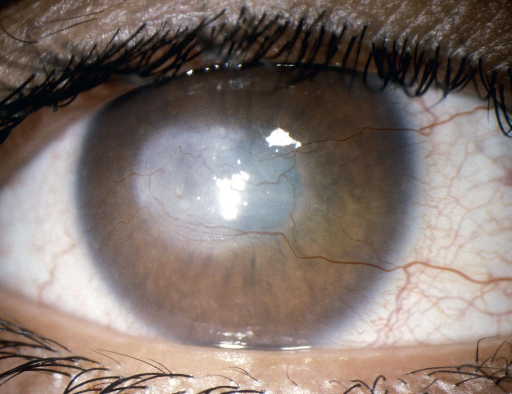 Fig. 15.8, Dense axial cornea scar associated with blepharokeratoconjunctivitis. The patient was relatively asymptomatic until a corneal opacity was noted.