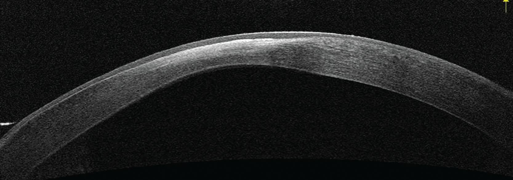 Fig. 15.9, Optical coherence tomography showing an area of anterior stromal scar and thinning. There is epithelial hyperplasia over the area of scar.